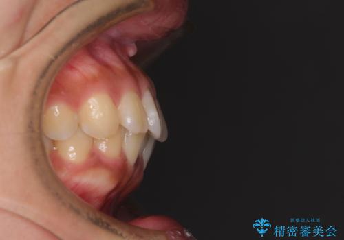 くちばしのような前歯　抜歯矯正で口を閉じやすくの治療前