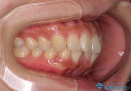 くちばしのような前歯 抜歯矯正で口を閉じやすくの治療前