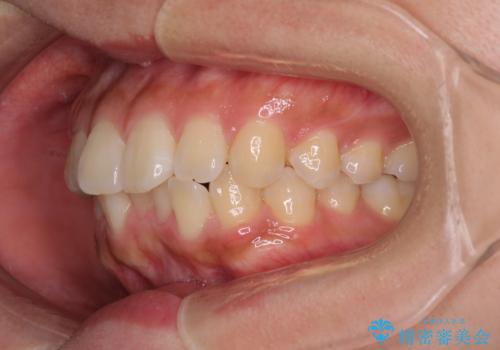 くちばしのような前歯　抜歯矯正で口を閉じやすくの治療前