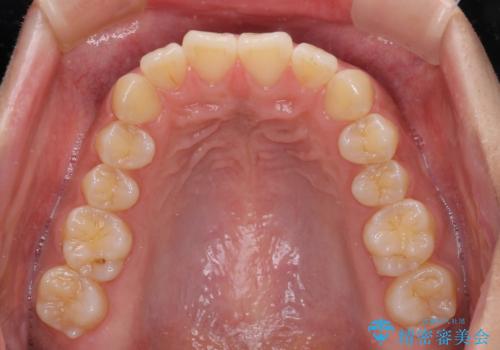 くちばしのような前歯 抜歯矯正で口を閉じやすくの治療前