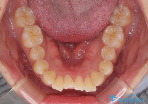 くちばしのような前歯 抜歯矯正で口を閉じやすくの治療前