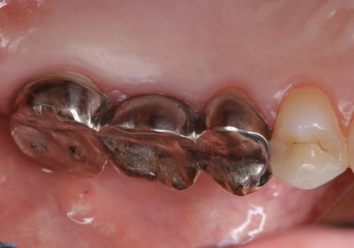 メタルフリー治療 保険の金属ブリッジから、自費のセラミックブリッジへの治療前