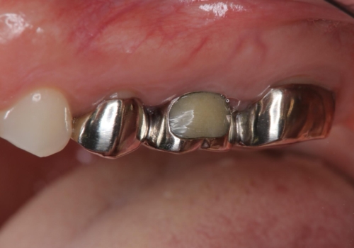 メタルフリー治療 保険の金属ブリッジから、自費のセラミックブリッジへの治療前