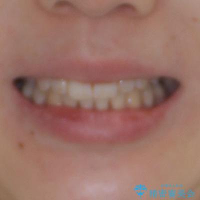 目立たない裏側装置でデコボコをきれいに解消の治療後(顔貌)