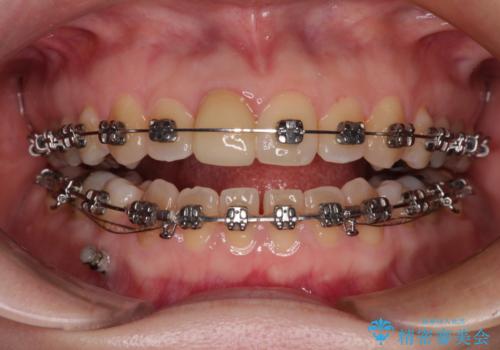 【モニター】後戻りでできた隙間 ワイヤー装置での再矯正の治療中