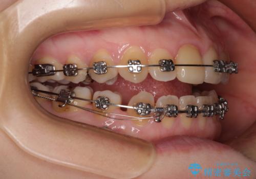 【モニター】後戻りでできた隙間 ワイヤー装置での再矯正の治療中