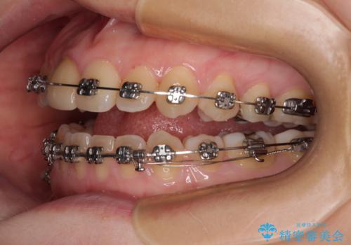 【モニター】後戻りでできた隙間 ワイヤー装置での再矯正の治療中