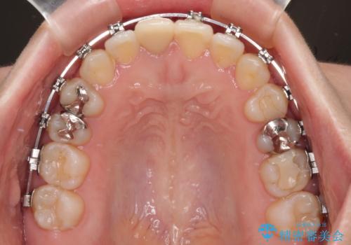 【モニター】後戻りでできた隙間 ワイヤー装置での再矯正の治療中