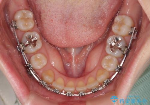 【モニター】後戻りでできた隙間 ワイヤー装置での再矯正の治療中