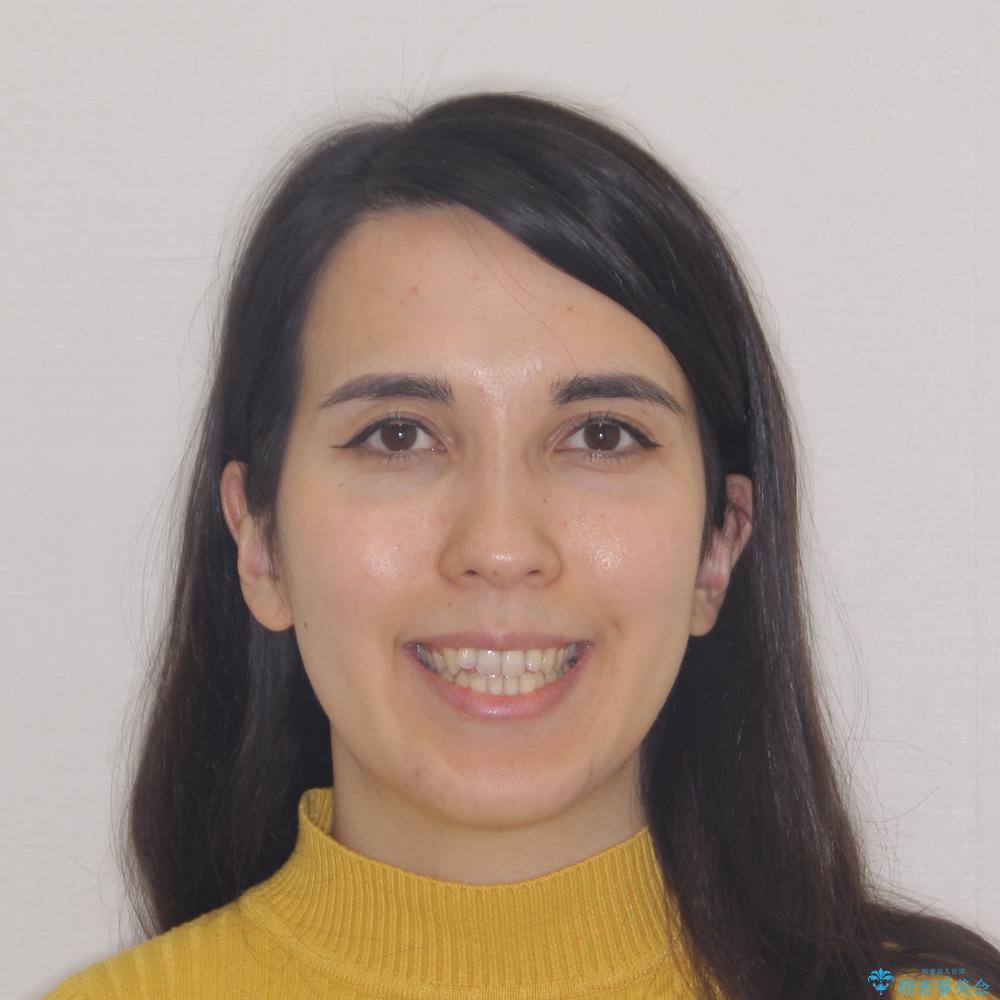 【モニター】オープンバイトをインビザライン矯正で治すの治療前(顔貌)