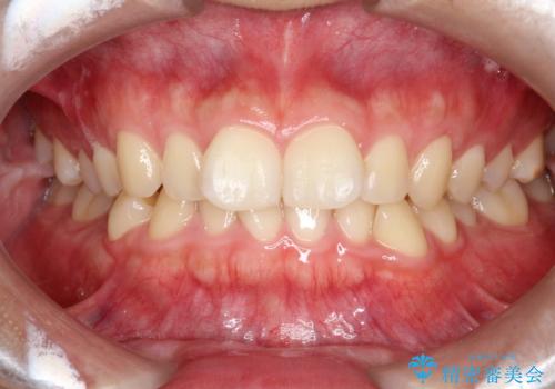 マウスピース矯正で前歯のガタツキを改善!　短期間で治療完了の症例 治療前