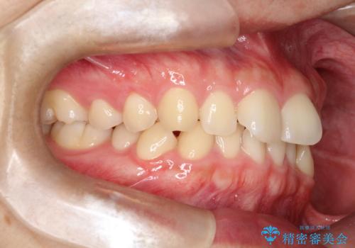 マウスピース矯正で前歯のガタツキを改善! 短期間で治療完了の治療前