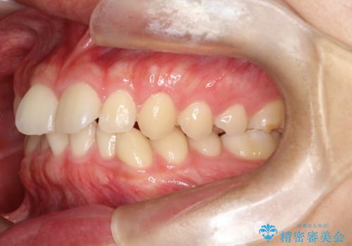 マウスピース矯正で前歯のガタツキを改善!　短期間で治療完了の治療前