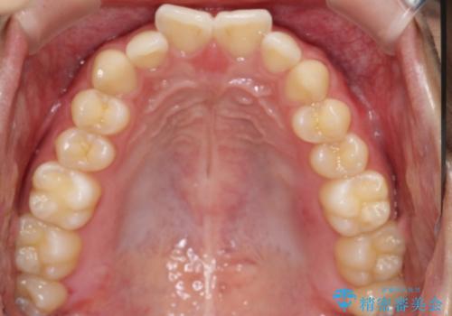 マウスピース矯正で前歯のガタツキを改善! 短期間で治療完了の治療前
