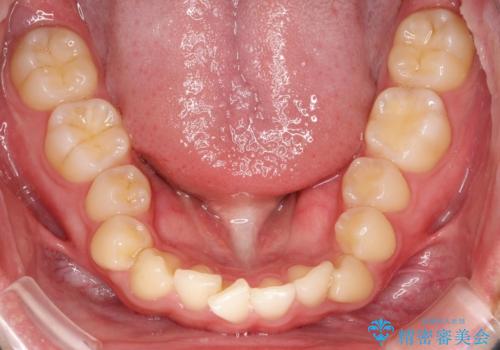 マウスピース矯正で前歯のガタツキを改善! 短期間で治療完了の治療前