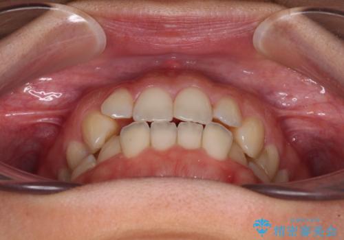 【モニター】オープンバイトをインビザライン矯正で治すの治療前