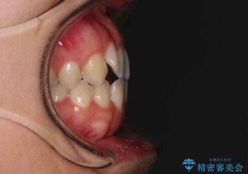 【モニター】オープンバイトをインビザライン矯正で治すの治療前