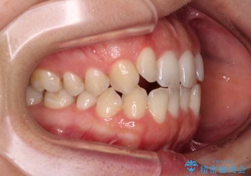 【モニター】オープンバイトをインビザライン矯正で治すの治療前