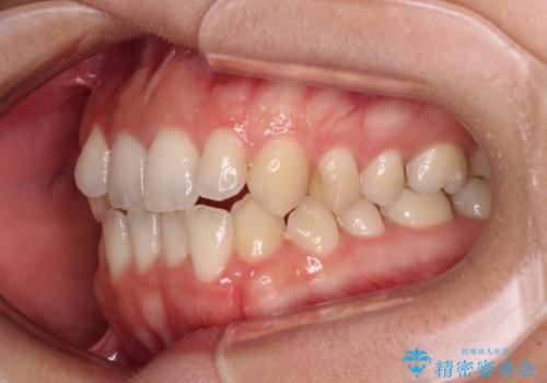 【モニター】オープンバイトをインビザライン矯正で治すの治療前