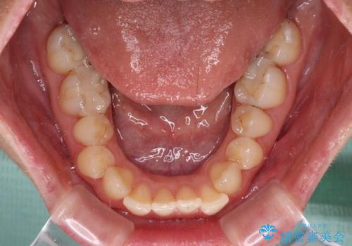 【モニター】オープンバイトをインビザライン矯正で治すの治療前