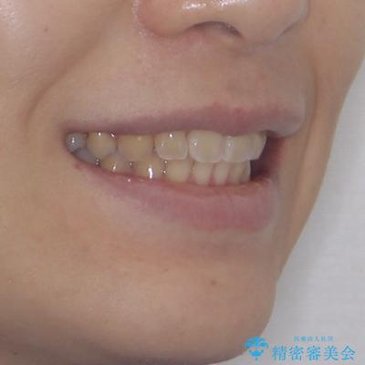 くちばしのような前歯 抜歯矯正で口を閉じやすくの治療後(顔貌)