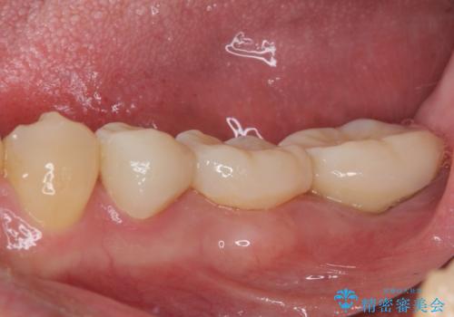 激痛の奥歯のむし歯治療 折角なので矯正治療もしたいの治療前