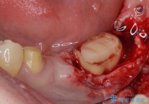 激痛の奥歯のむし歯治療 折角なので矯正治療もしたいの治療中
