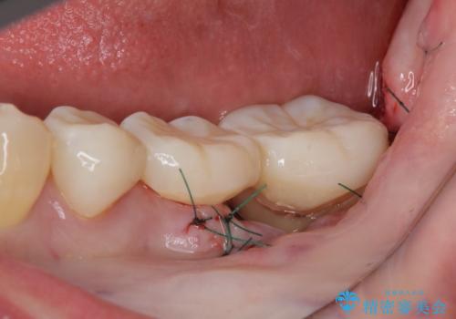 激痛の奥歯のむし歯治療 折角なので矯正治療もしたいの治療中