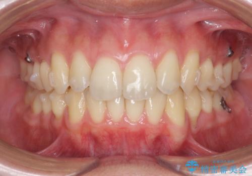 過蓋咬合・上顎前突・叢生を改善するマウスピース矯正の治療中
