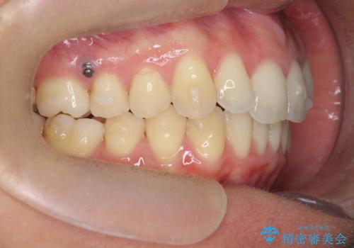 過蓋咬合・上顎前突・叢生を改善するマウスピース矯正の治療中