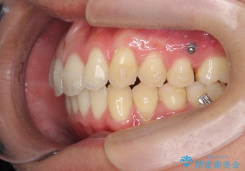 過蓋咬合・上顎前突・叢生を改善するマウスピース矯正の治療中