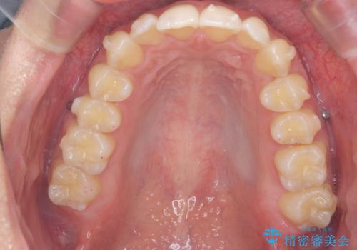 過蓋咬合・上顎前突・叢生を改善するマウスピース矯正の治療中