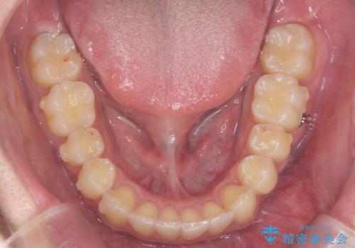 過蓋咬合・上顎前突・叢生を改善するマウスピース矯正の治療中