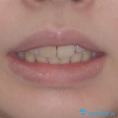 矯正の後戻りと奥歯の欠損 ワイヤー矯正とインプラント治療の治療前(顔貌)