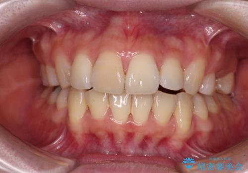 矯正の後戻りと奥歯の欠損 ワイヤー矯正とインプラント治療の症例 治療前