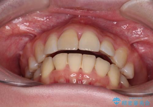 矯正の後戻りと奥歯の欠損 ワイヤー矯正とインプラント治療の治療前