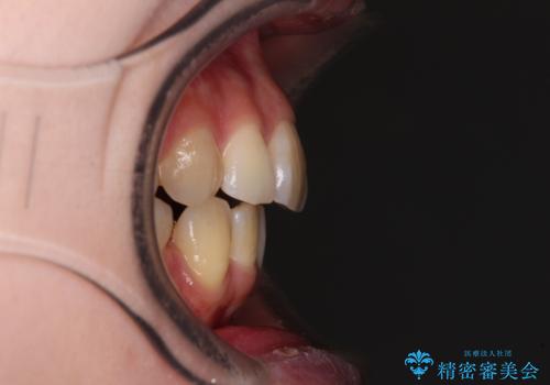 矯正の後戻りと奥歯の欠損 ワイヤー矯正とインプラント治療の治療前