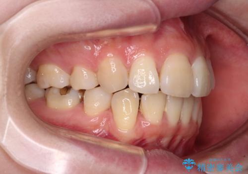 矯正の後戻りと奥歯の欠損　ワイヤー矯正とインプラント治療の治療前