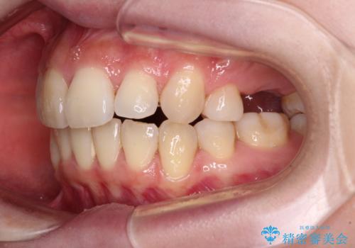 矯正の後戻りと奥歯の欠損 ワイヤー矯正とインプラント治療の治療前