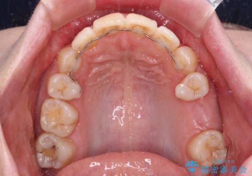 矯正の後戻りと奥歯の欠損 ワイヤー矯正とインプラント治療の治療前