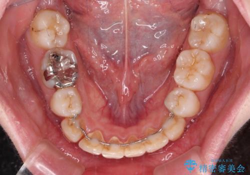 矯正の後戻りと奥歯の欠損 ワイヤー矯正とインプラント治療の治療前