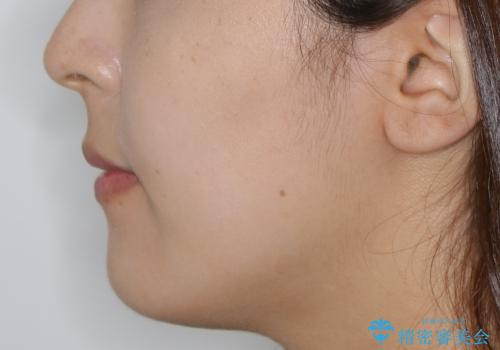 【抜歯】口元を引っ込めたい ワイヤー矯正