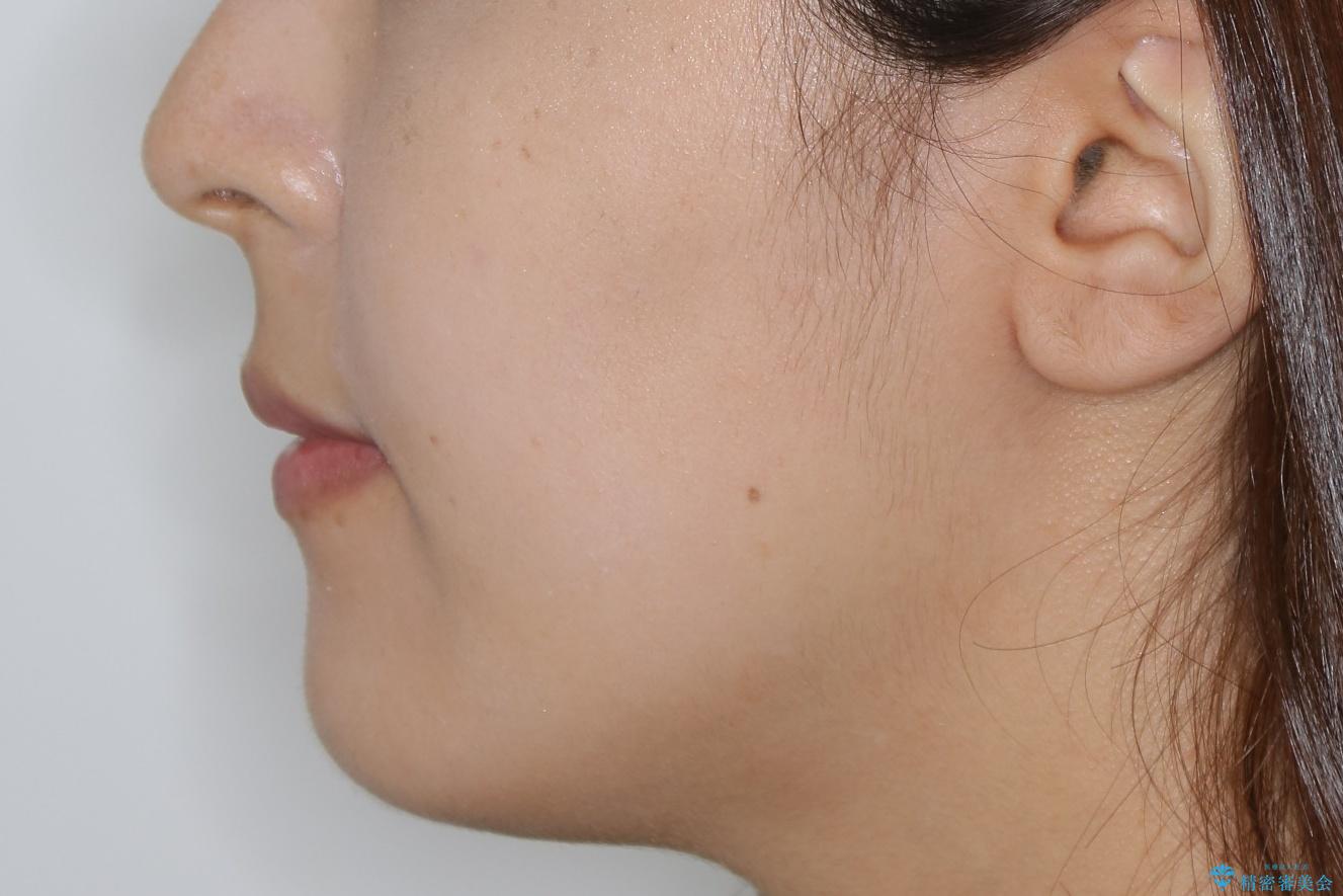 【抜歯】口元を引っ込めたい ワイヤー矯正の治療後(顔貌)