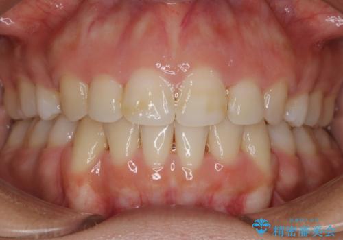 【抜歯】口元を引っ込めたい ワイヤー矯正の治療後