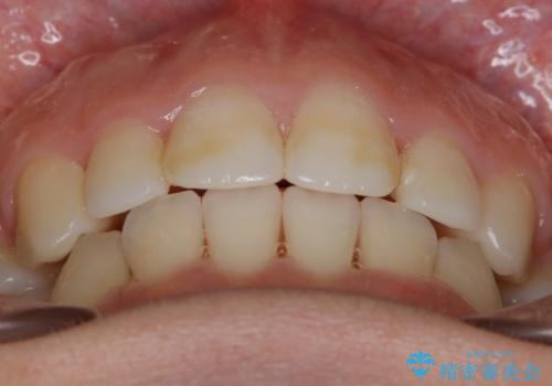 【抜歯】口元を引っ込めたい ワイヤー矯正の治療後