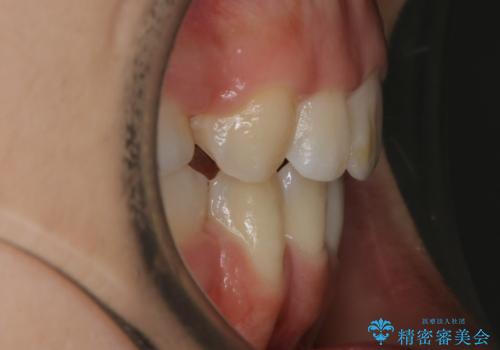 【抜歯】口元を引っ込めたい ワイヤー矯正の治療後
