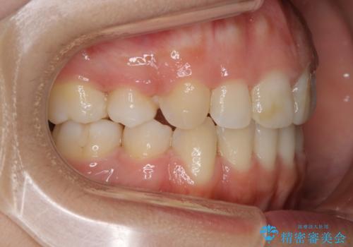 【抜歯】口元を引っ込めたい ワイヤー矯正の治療後