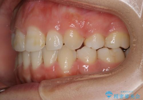 【抜歯】口元を引っ込めたい ワイヤー矯正の治療後