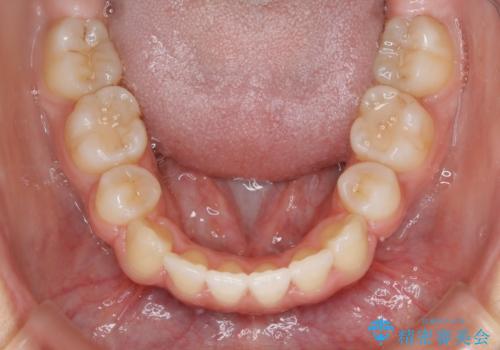 【抜歯】口元を引っ込めたい ワイヤー矯正の治療後