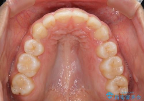 【抜歯】口元を引っ込めたい ワイヤー矯正の治療後
